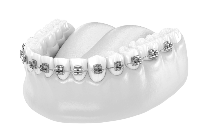 Conventional Metal Braces